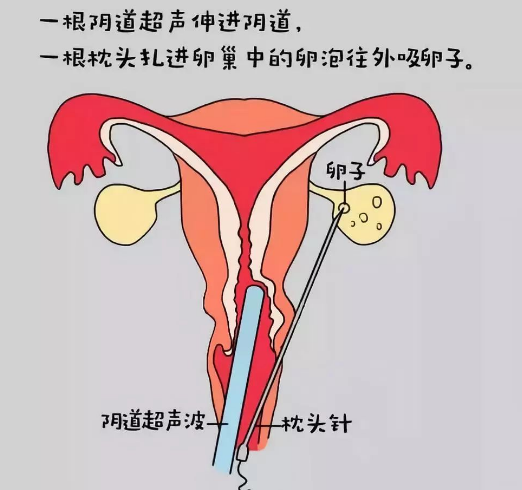 激素六项检查解读：FSH、LH、雌二醇在试管周期中的参考价值